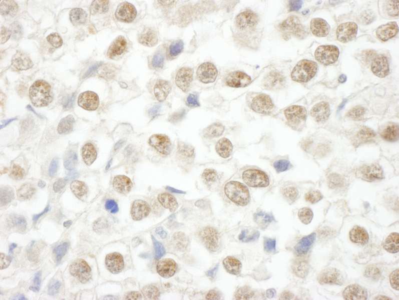 Detection of Human ARID2 by Immunohistochemistry. Sample: FFPE section of human testicular seminoma Antibody: Affinity purified rabbit anti-ARID2 used at a dilution of 1:250.