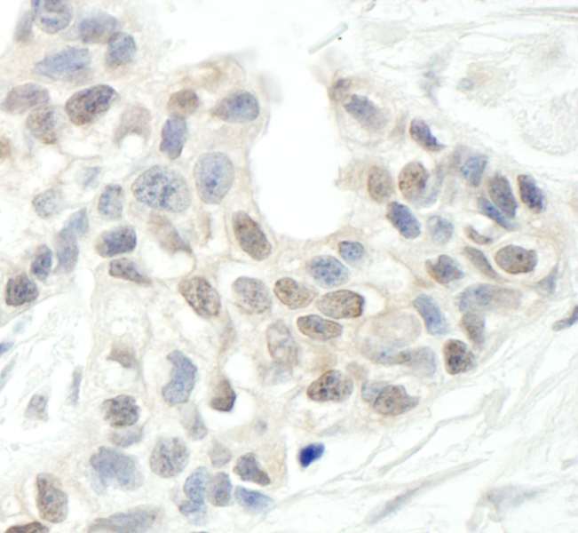 Detection of Human ARID2 by Immunohistochemistry. Sample: FFPE section of human breast carcinoma. Antibody: Affinity purified rabbit anti-ARID2 used at a dilution of 1:1000 (1 ug/ml).