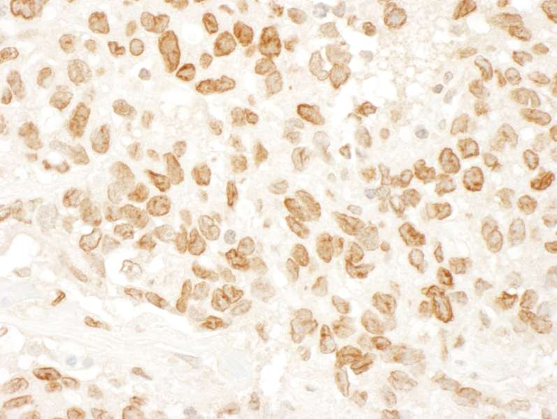Detection of Human ARID4B by Immunohistochemistry. Sample: FFPE section of human ovarian carcinoma. Antibody: Affinity purified rabbit anti-ARID4B used at a dilution of 1:1000 (1 ug/ml).