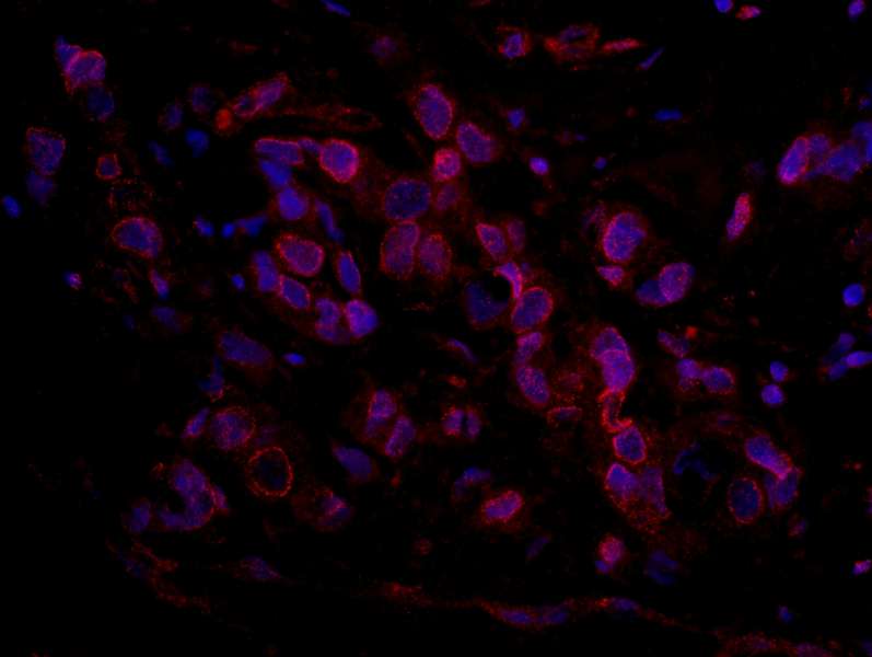 Detection of Human ARID4B by Immunohistochemistry. Sample: FFPE section of human ovarian carcinoma. Antibody: Affinity purified rabbit anti-ARID4B used at a dilution of 1:100. Detection: Red-fluorescent Goat anti-Rabbit IgG-heavy and light chain cross-adsorbed Antibody DyLight 594 Conjugated (A120-601D4) used at a dilution of 1:100.
