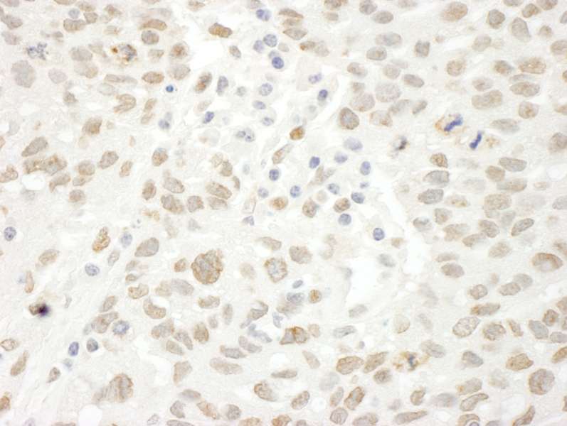 Detection of Human ARID4B by Immunohistochemistry. Sample: FFPE section of human ovarian carcinoma. Antibody: Affinity purified rabbit anti-ARID4B used at a dilution of 1:250.