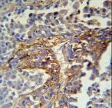 ARMC5 Antibody immunohistochemistry of formalin-fixed and paraffin-embedded human skin carcinoma followed by peroxidase-conjugated secondary antibody and DAB staining.