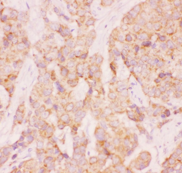 AAMP antibody IHC-paraffin: Human Mammary Cancer Tissue.