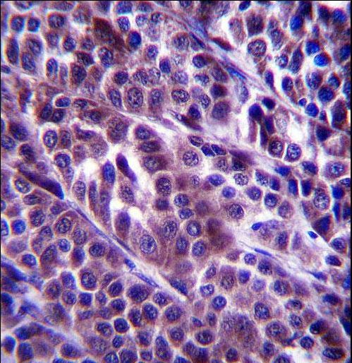ARMC9 Antibody immunohistochemistry of formalin-fixed and paraffin-embedded human melanoma followed by peroxidase-conjugated secondary antibody and DAB staining.