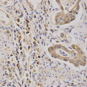 Immunohistochemistry of paraffin-embedded human stomach cancer using ARPC1A antibody at dilution of 1:200 (x400 lens).