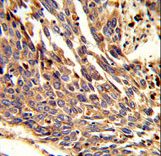 Formalin-fixed and paraffin-embedded human lung carcinoma reacted with ARPC1B Antibody , which was peroxidase-conjugated to the secondary antibody, followed by DAB staining. This data demonstrates the use of this antibody for immunohistochemistry; clinical relevance has not been evaluated.