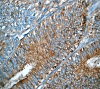 IHC of paraffin-embedded human uterus adenocarcinoma using anti-p16-ARC antibody.