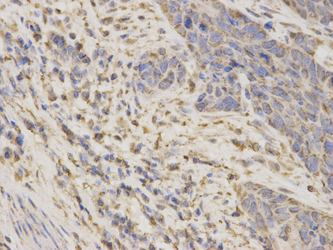Immunohistochemistry of paraffin-embedded human esophageal cancer using ARSA antibody at dilution of 1:200 (400x lens).
