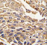 Formalin-fixed and paraffin-embedded human lung carcinoma tissue reacted with ARSB antibody , which was peroxidase-conjugated to the secondary antibody, followed by DAB staining. This data demonstrates the use of this antibody for immunohistochemistry; clinical relevance has not been evaluated.