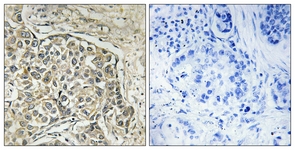 IHC of paraffin-embedded human lung carcinoma tissue, using ARSD Antibody. The picture on the right is treated with the synthesized peptide.