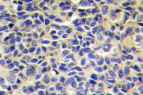 IHC of ERAP1 (K467) pAb in paraffin-embedded human breast carcinoma tissue.