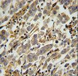 ASB17 Antibody immunohistochemistry of formalin-fixed and paraffin-embedded human testis carcinoma followed by peroxidase-conjugated secondary antibody and DAB staining.