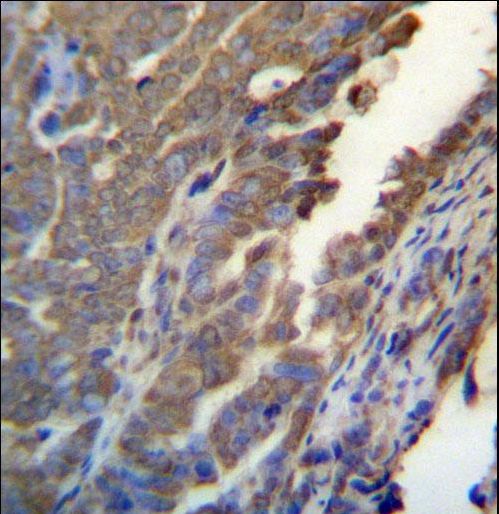 ASB4 Antibody immunohistochemistry of formalin-fixed and paraffin-embedded human ovarian carcinoma followed by peroxidase-conjugated secondary antibody and DAB staining.