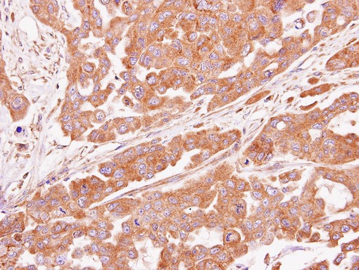 IHC of paraffin-embedded OVCAR3 xenograft using ASB4 antibody at 1:100 dilution.