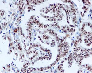 IHC of paraffin-embedded human thyroid gland adenocarcinoma tissue using anti-DDX50 antibody.