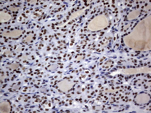 IHC of paraffin-embedded Carcinoma of Human thyroid tissue using anti-DDX56 mouse monoclonal antibody. (Heat-induced epitope retrieval by 10mM citric buffer, pH6.0, 120°C for 3min).
