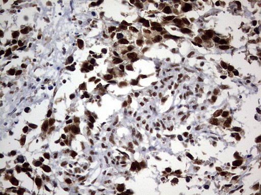 IHC of paraffin-embedded Adenocarcinoma of Human ovary tissue using anti-DDX56 mouse monoclonal antibody. (Heat-induced epitope retrieval by 10mM citric buffer, pH6.0, 120°C for 3min).