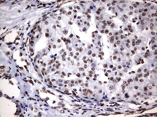 IHC of paraffin-embedded Carcinoma of Human liver tissue using anti-DDX56 mouse monoclonal antibody. (Heat-induced epitope retrieval by 10mM citric buffer, pH6.0, 120°C for 3min).