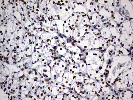 IHC of paraffin-embedded Carcinoma of Human kidney tissue using anti-DDX56 mouse monoclonal antibody. (Heat-induced epitope retrieval by 10mM citric buffer, pH6.0, 120°C for 3min).