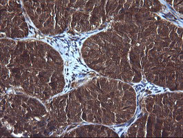 IHC of paraffin-embedded Adenocarcinoma of Human ovary tissue using anti-DDX58 mouse monoclonal antibody.