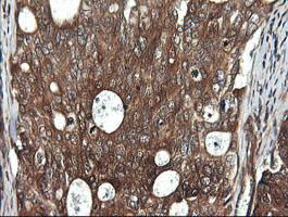 IHC of paraffin-embedded Adenocarcinoma of Human breast tissue using anti-DDX58 mouse monoclonal antibody.