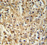 DDX6 Antibody IHC of formalin-fixed and paraffin-embedded breast carcinoma followed by peroxidase-conjugated secondary antibody and DAB staining.