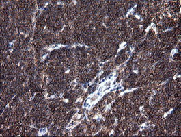 IHC of paraffin-embedded Human lymphoma tissue using anti-DEF6 mouse monoclonal antibody. (Heat-induced epitope retrieval by 10mM citric buffer, pH6.0, 100C for 10min).
