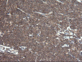 IHC of paraffin-embedded Human lymphoma tissue using anti-DEF6 mouse monoclonal antibody.