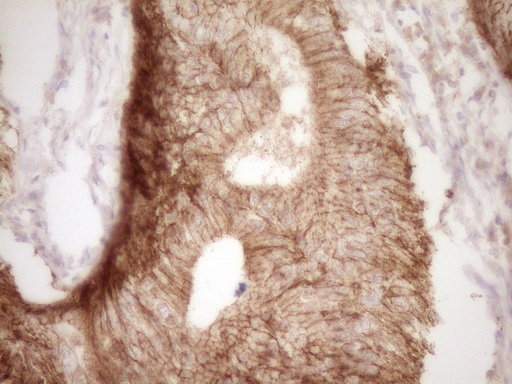 IHC of paraffin-embedded Adenocarcinoma of Human colon tissue using anti-CLDN3 mouse monoclonal antibody. (Heat-induced epitope retrieval by 1 mM EDTA in 10mM Tris, pH8.5, 120°C for 3min).