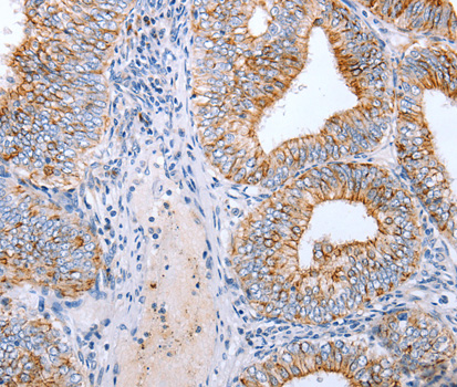 Immunohistochemistry of paraffin-embedded human cervical cancer tissue using CLDN3 antibody.