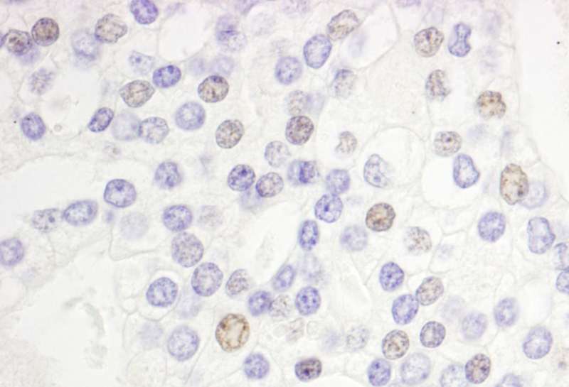 Detection of Human DEK by Immunohistochemistry. Sample: FFPE section of human prostate carcinoma. Antibody: Affinity purified rabbit anti-DEK used at a dilution of 1:1000 (1 ug/ml). Detection: DAB.
