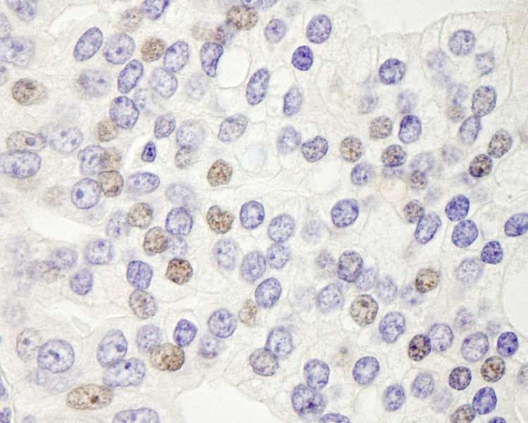 Detection of Human DEK by Immunohistochemistry. Sample: FFPE section of human prostate carcinoma. Antibody: Affinity purified rabbit anti-DEK used at a dilution of 1:250.