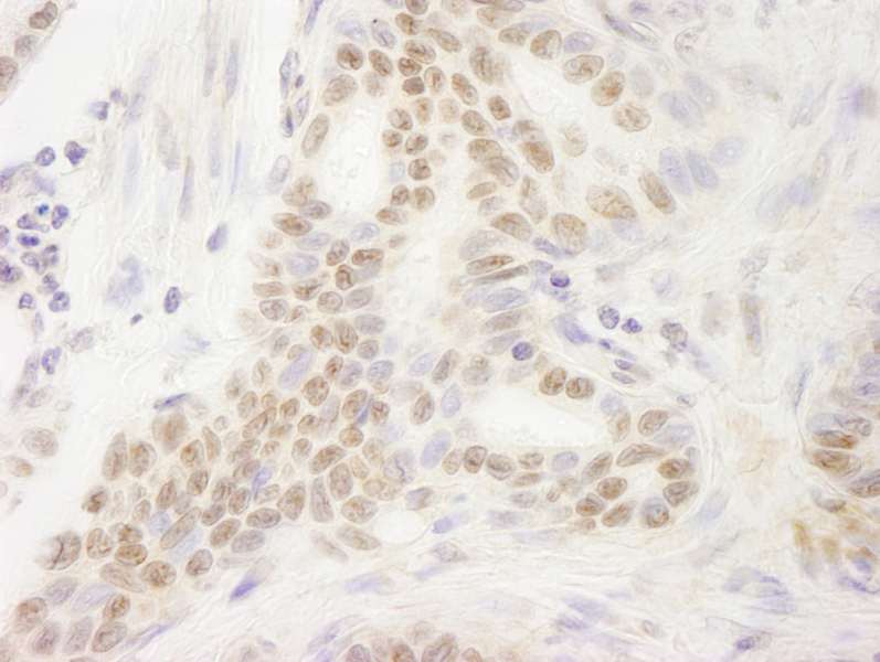 Detection of Human DEK by Immunohistochemistry. Sample: FFPE section of human stomach carcinoma. Antibody: Affinity purified rabbit anti-DEK used at a dilution of 1:250.