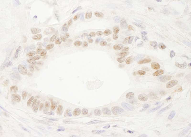 Detection of Human DEK by Immunohistochemistry. Sample: FFPE section of human stomach carcinoma. Antibody: Affinity purified rabbit anti-DEK used at a dilution of 1:200 (1 ug/ml). Detection: DAB.