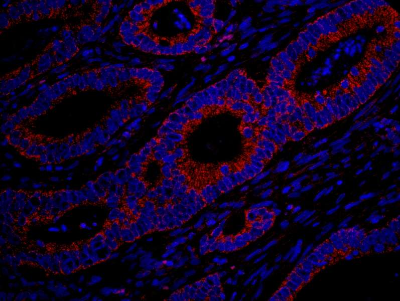 Detection of Human MADD by Immunohistochemistry. Sample: FFPE section of human colon carcinoma. Antibody: Affinity purified rabbit anti-MADD used at a dilution of 1:100. Detection: Red-fluorescent Goat anti-Rabbit IgG-heavy and light chain cross-adsorbed Antibody DyLight 594 Conjugated (A120-601D4) used at a dilution of 1:100.