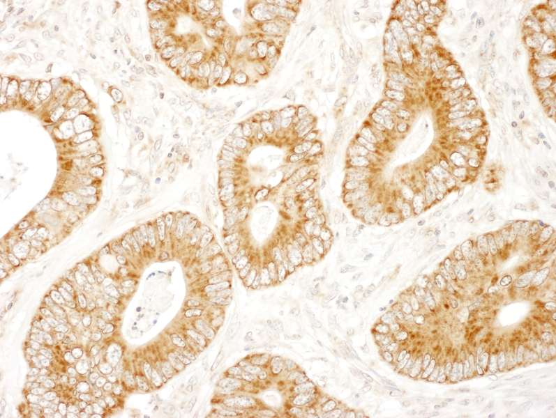 Detection of Human MADD by Immunohistochemistry. Sample: FFPE section of human colon carcinoma. Antibody: Affinity purified rabbit anti-MADD used at a dilution of 1:100.