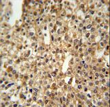 DEN1A Antibody IHC of formalin-fixed and paraffin-embedded human cervix carcinoma followed by peroxidase-conjugated secondary antibody and DAB staining.