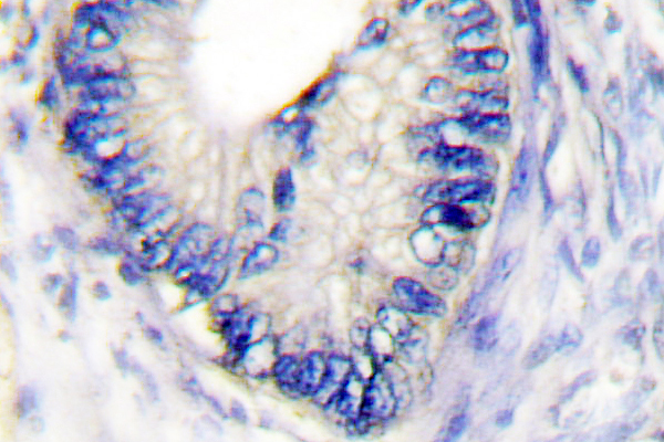 IHC of Claudin 3 (T204) pAb in paraffin-embedded human colon carcinoma tissue.