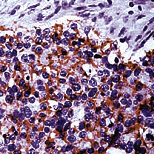 Formalin-fixed, paraffin-embedded human ovarian carcinoma stained with Claudin 4 antibody LS-C95986.