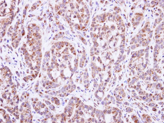 IHC of paraffin-embedded A549 xenograft using DGAT2 antibody at 1:100 dilution.