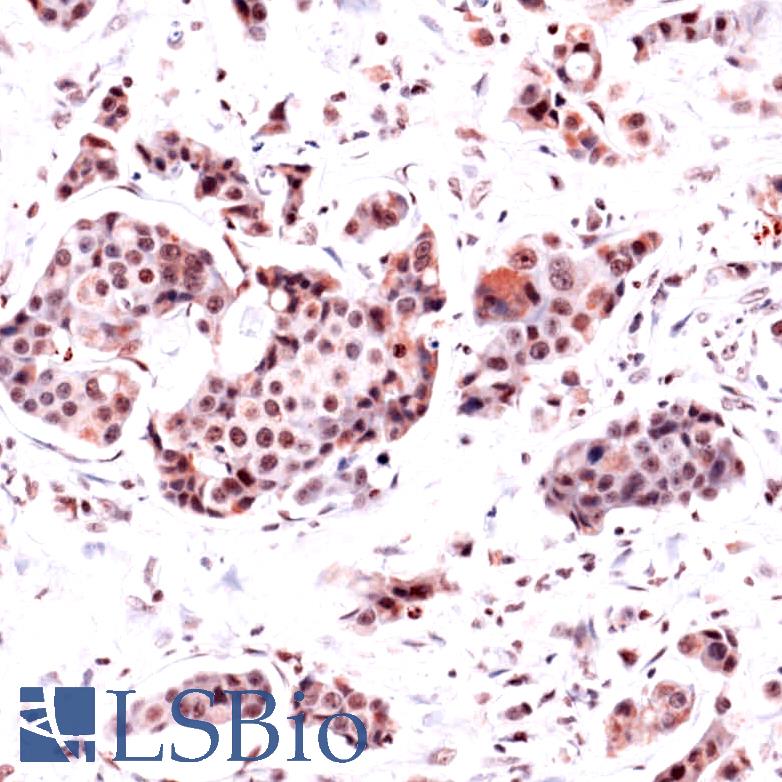 Immunohistochemistry of Human Breast Carcinoma stained with anti-DHFR antibody