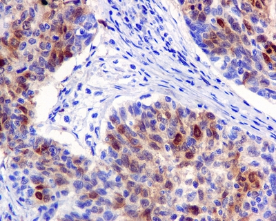 IHC of paraffin-embedded cervical carcinoma tissue using anti-DHFR antibody.