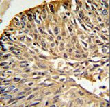 DHFR Antibody IHC of formalin-fixed and paraffin-embedded human lung carcinoma followed by peroxidase-conjugated secondary antibody and DAB staining.