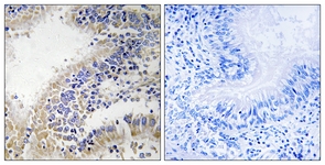 IHC of paraffin-embedded human breast carcinoma tissue, using DHODH Antibody. The sample on the right was incubated with synthetic peptide.