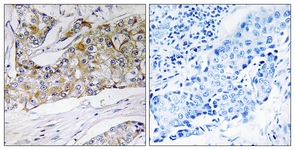 IHC of paraffin-embedded human breast carcinoma tissue, using DHRS11 Antibody. The sample on the right was incubated with synthetic peptide.