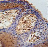 DHRS2 Antibody immunohistochemistry of formalin-fixed and paraffin-embedded human skin carcinoma followed by peroxidase-conjugated secondary antibody and DAB staining.