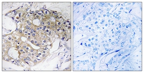 IHC of paraffin-embedded human breast carcinoma tissue, using DHRS4 Antibody. The picture on the right is treated with the synthesized peptide.