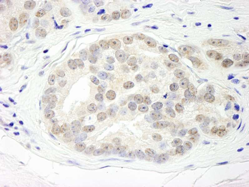 Detection of Human DHX15 by Immunohistochemistry. Sample: FFPE section of human prostate carcinoma. Antibody: Affinity purified rabbit anti-DHX15 used at a dilution of 1:1000 (1 ug/ml). Detection: DAB.