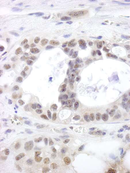 Detection of Human DHX15 by Immunohistochemistry. Sample: FFPE section of human ovarian tumor. Antibody: Affinity purified rabbit anti-DHX15 used at a dilution of 1:250.