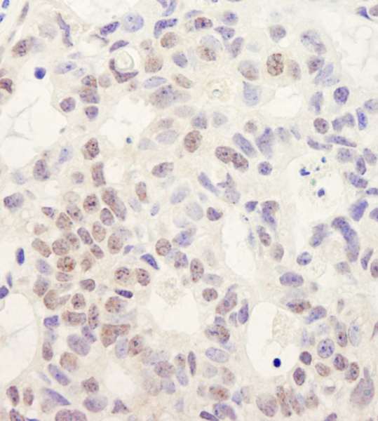 Detection of Human DHX38 by Immunohistochemistry. Sample: FFPE section of human breast carcinoma. Antibody: Affinity purified rabbit anti-DHX38 used at a dilution of 1:200 (1 ug/ml). Detection: DAB.